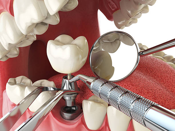 Best Emergency Root Canal Treatment in Lonoke, AR